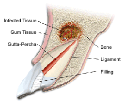 apicoectomy graphyc